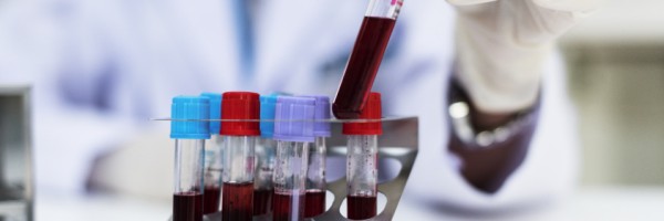 Diagnosing Hypothyroidism (Underactive Thyroid): Interpreting Thyroid Blood Tests And TSH Levels